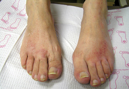 Foot fungal infection